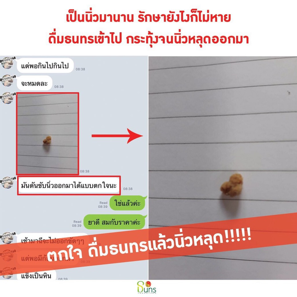 รักษานิ่วด้วยตัวเองpantip
