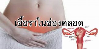 โรคเชื้อราในช่องคลอด ป้องกันได้ด้วย ชุดป้องกัน เซอร์นิติน Cernitin