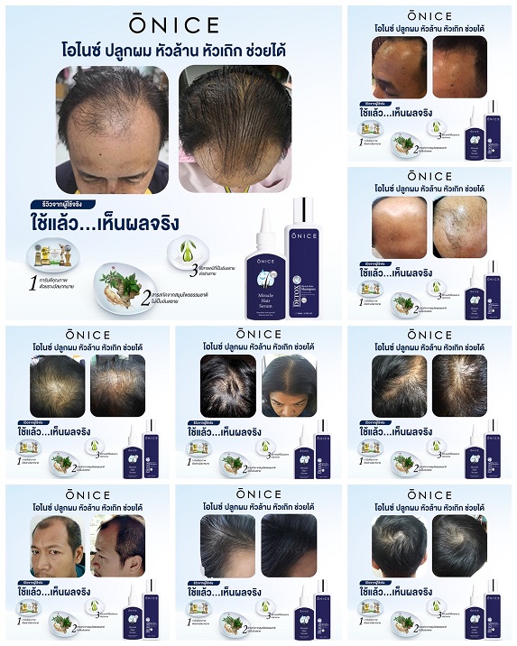 onice onicethai onicehairserum onicemiracle onicebeauty เซรั่มปลูกผม ของ ชาคริต แย้มนาม แก้ปัญหา หัวล้าน ล้านกรรมพันธุ์ โอไนซ์ ลดผมร่วง เพิ่มผมหนา ผมบาง หัวเถิก รีวิวมากมาย serumonice oniceserum oniceราคา ไม่แพง มีโปรโมชั่น 1 แถม 1 รับของแถมเลือกได้ onic