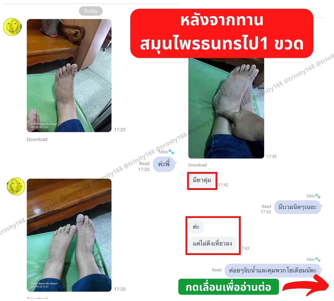 ตาตุ่มบวม