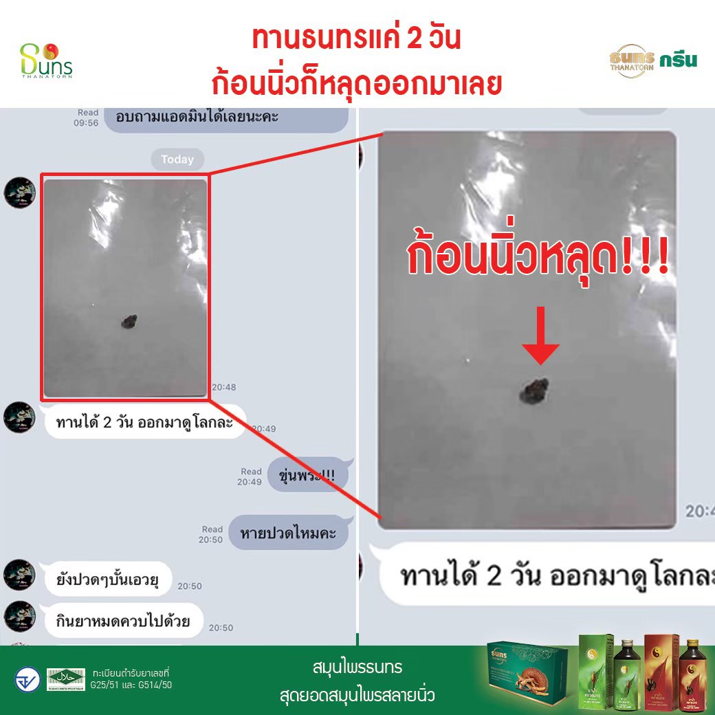 สมุนไพรธนทร ช่วยรักษานิ่วในไต