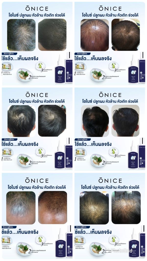 โปร 1 แถม 2 เซรั่มปลูกผม เพิ่มผมหนา ลดผมร่วง ผมบาง ล้านกรรมพันธุ์ (ONICE โอไนซ์)
